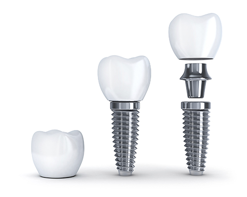 2 Dental Implants Pieces Diagram iStock 000077095183 Large 500px