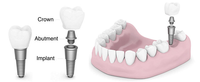 3 dental implant 1514284970881