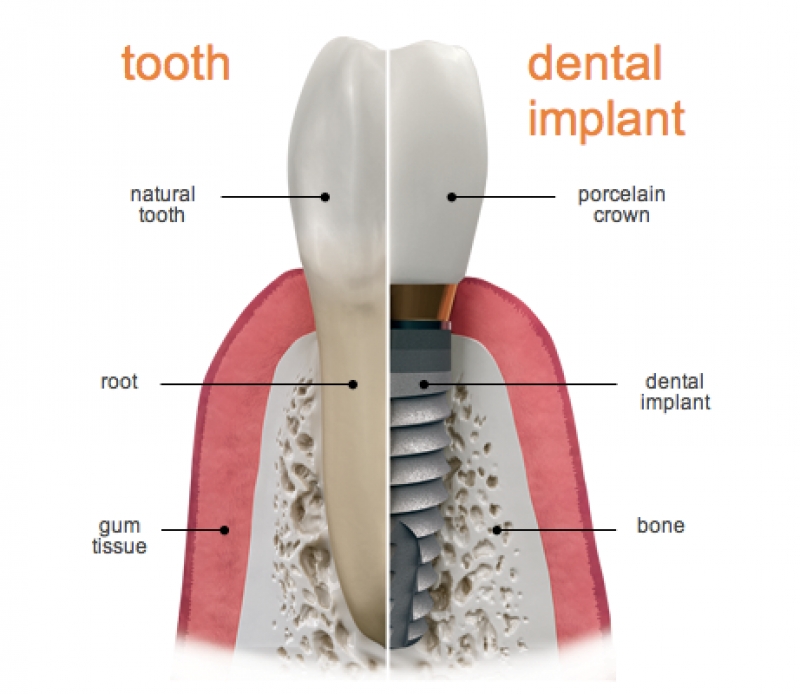 Dental Implants